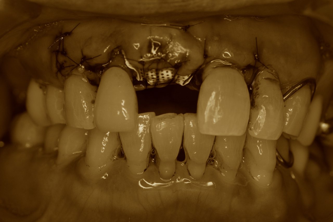 あかなべ歯科 インプラント