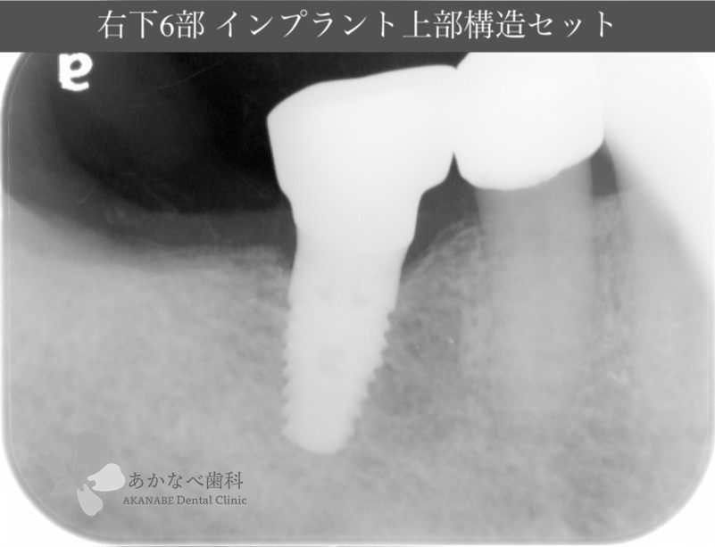 あかなべ歯科_右下6インプラント上部構造セット_20200609_術後レントゲン写真