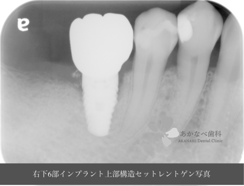 あかなべ歯科_右下6インプラント上部構造セット_20200912_術後レントゲン写真