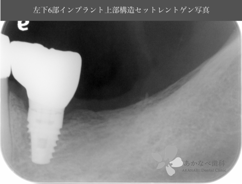 あかなべ歯科_左下6インプラント上部構造セット_20200627_術後レントゲン写真