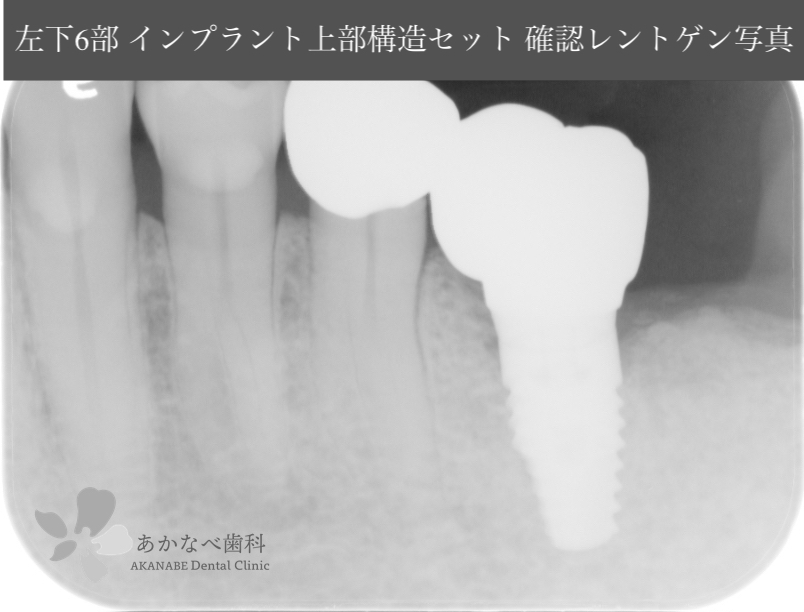 あかなべ歯科_左下6インプラント上部構造セット_20200910_術後レントゲン写真