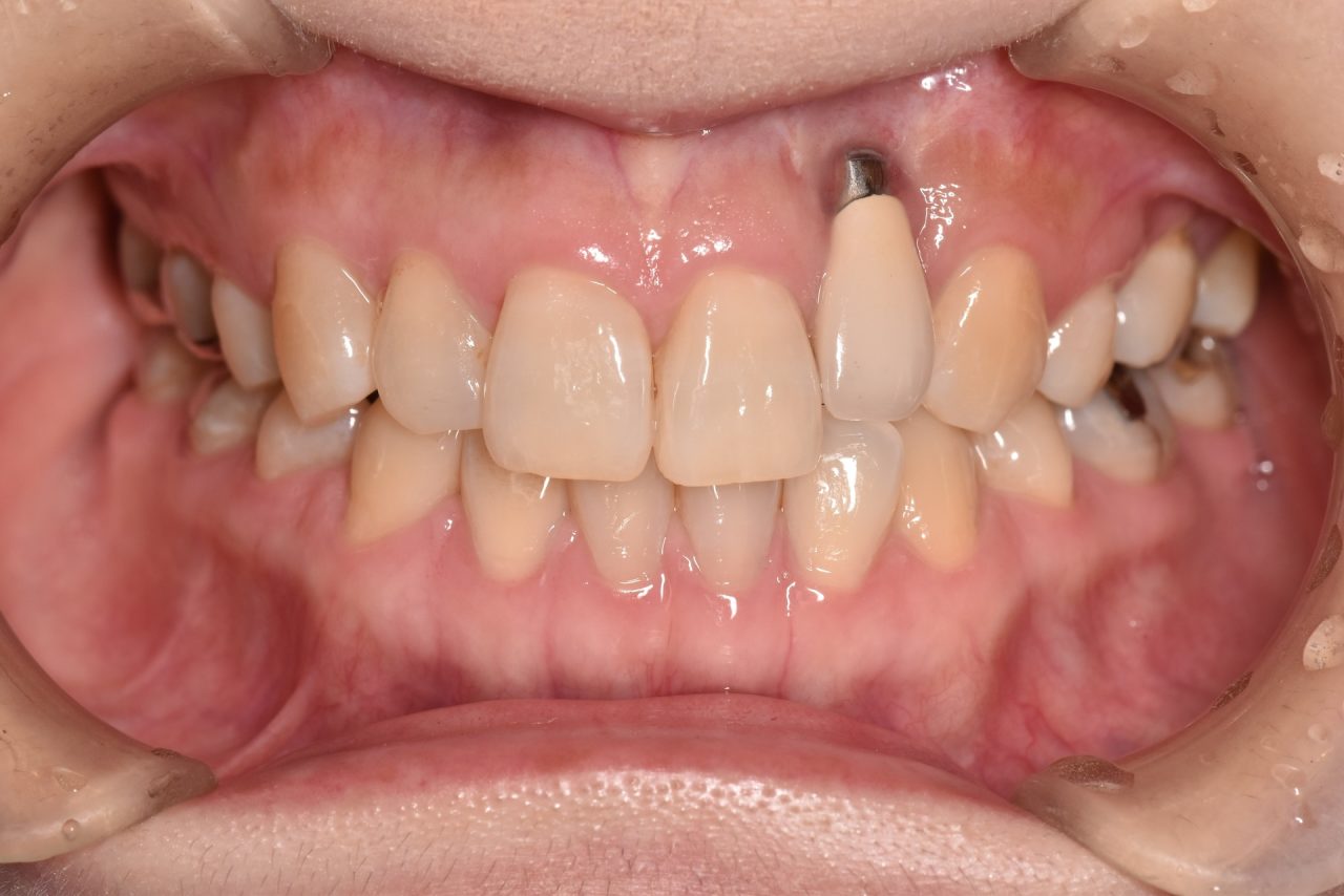 あかなべ歯科_右上2インプラント_他院失敗