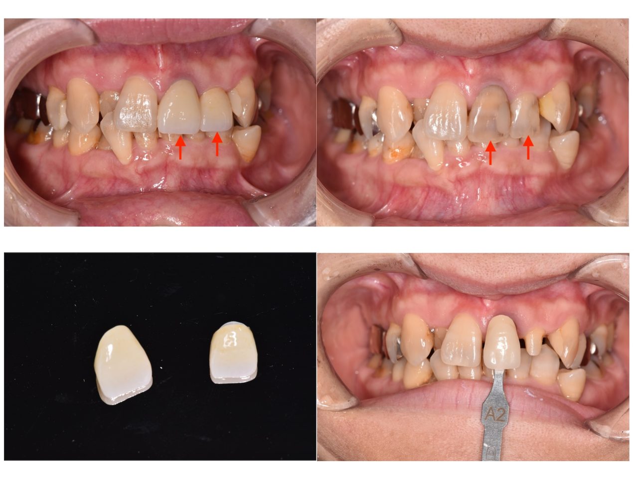 あかなべ歯科_セラミック治療_2