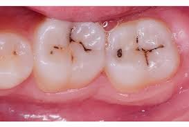 あかなべ歯科_小窩裂溝