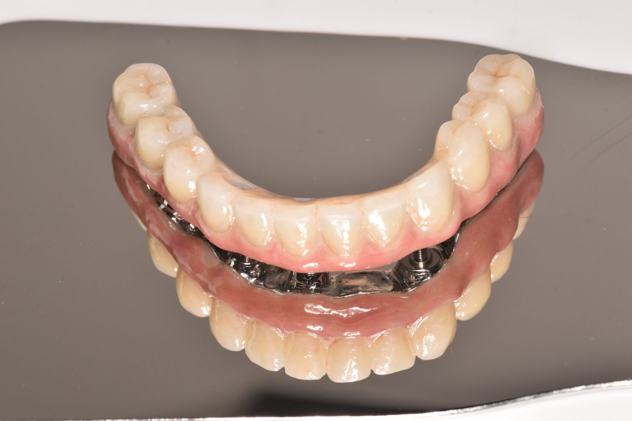 あかなべ歯科_インプラント_オールオン4