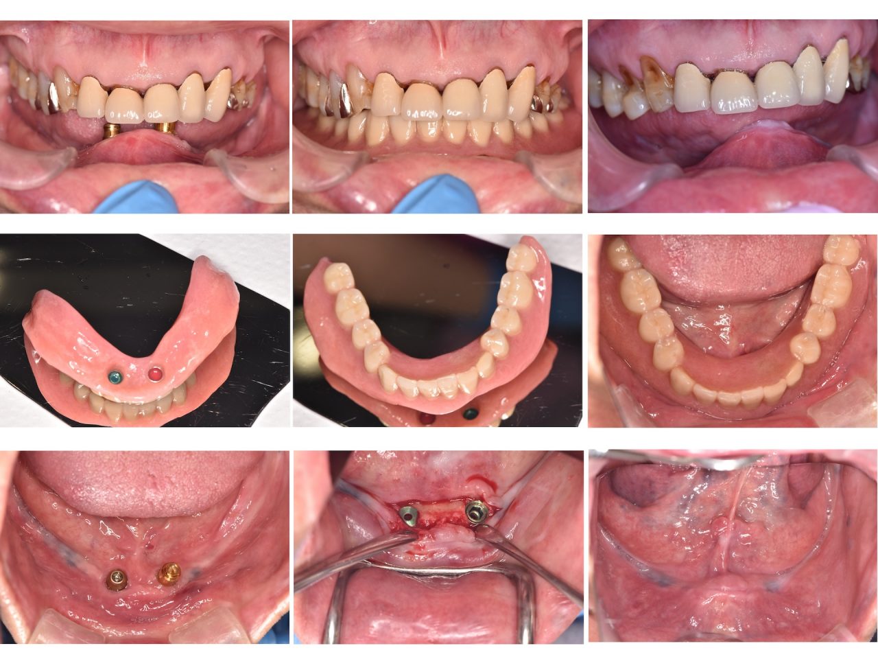 あかなべ歯科_インプラント義歯