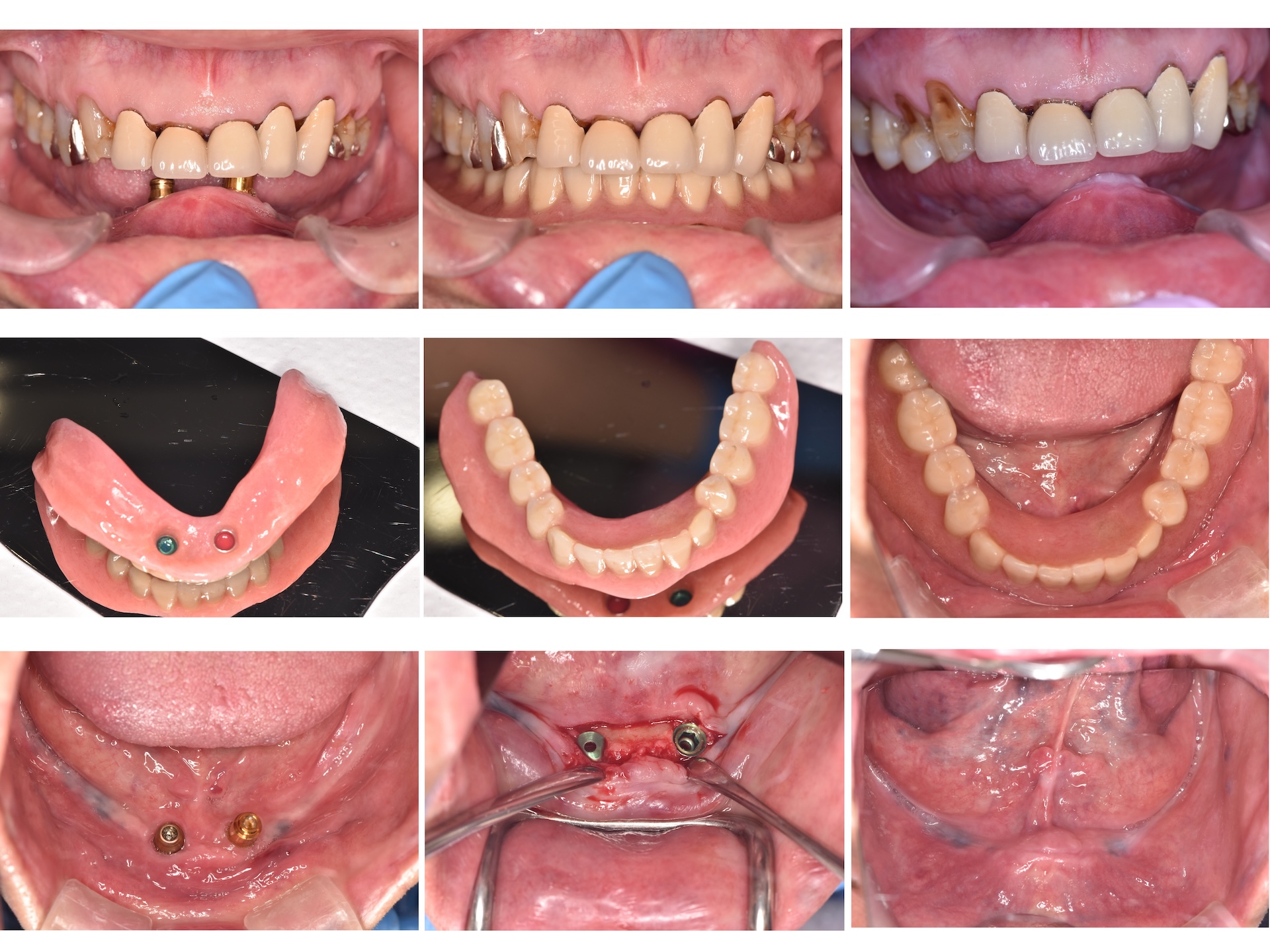 あかなべ歯科_インプラント義歯
